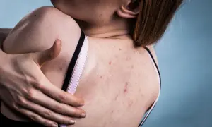 Skóra na plecach z widocznymi zmianami, które mogą wskazywać na trądzik grzybiczy.