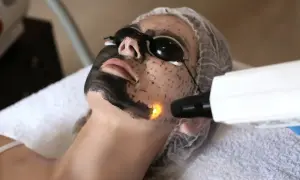 Kobieta z czarną maską na twarzy i okularami ochronnymi poddaje się zabiegowi laserowego peelingu węglowego.