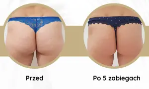 Widoczne **efekty endermologii** po 5 zabiegach: wygładzona skóra pośladków, redukcja cellulitu i poprawa jędrności.