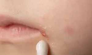 Zajady na ustach smarowane Tribiotic.