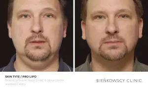 Przed i po zabiegu lipolizy iniekcyjnej. Widoczna redukcja tkanki tłuszczowej i obkurczenie skóry podbródka.