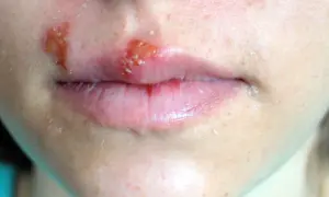 Opryszczka na ustach i policzku, która wygląda jak nieestetyczny pryszcz.