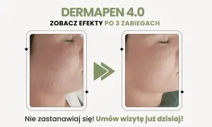 Przed i po zabiegu Dermapen 4.0: widoczne dermapen efekty po 3 zabiegach, skóra gładsza i bez niedoskonałości.
