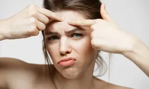 Kobieta z frustracją ogląda swój trądzik neuropatyczny na czole, próbując go nacisnąć.