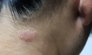 Zmiana skórna na policzku, widoczny nieleczony łupież pstry. Skóra jest zaczerwieniona i lekko łuszcząca się.