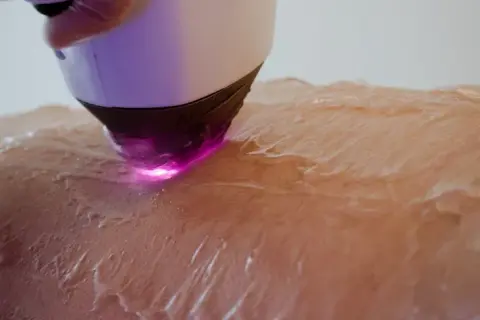depilacja laserowa