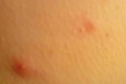 Widoczne czerwone krosty na pośladkach, niektóre z białymi czubkami, świadczą o podrażnieniu skóry.
