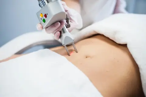 Zabieg liposukcji kawitacyjnej na brzuchu. Sprawdź, jaka jest liposukcja kawitacyjna cena i zacznij modelować sylwetkę.