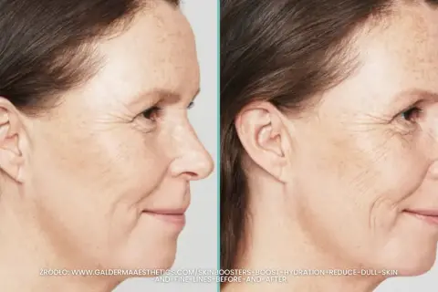 Porównanie skóry przed i po zabiegu skinbooster. Widać wygładzenie drobnych zmarszczek i poprawę nawilżenia.
