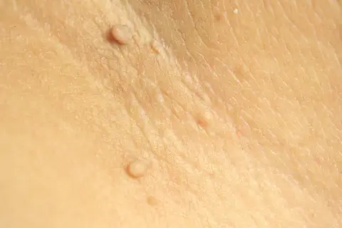 Zbliżenie na skórę z widocznymi włókniakami pod pachami. Drobne, cieliste narośla na lekko pomarszczonej skórze.