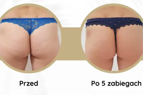 Widoczne **efekty endermologii** po 5 zabiegach: wygładzona skóra pośladków, redukcja cellulitu i poprawa jędrności.