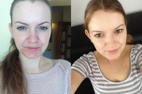Przed i po leczeniu trądziku. Na lewym zdjęciu widać nasilone zmiany, na prawym gładką cerę. Czy to skutki uboczne izoteku? Forum dyskusyjne.