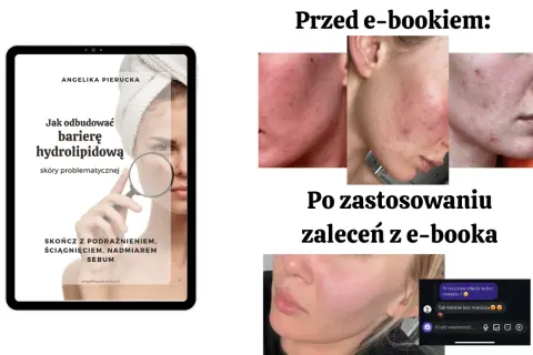 Skuteczne sposoby na czerwone plamy po pryszczach i ich redukcję