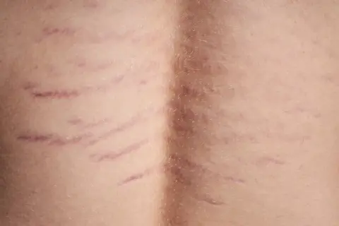 Widoczne rozstępy na plecach, świadectwo zmian w skórze, tworzą delikatny wzór na jasnej karnacji.