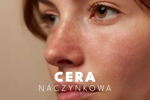 Zbliżenie na twarz z widocznymi rumieńcami i drobnymi naczynkami. Tekst: CERA NACZYŃKOWA.