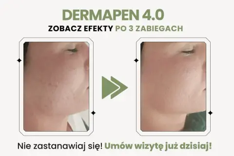 Przed i po zabiegu Dermapen 4.0: widoczne dermapen efekty po 3 zabiegach, skóra gładsza i bez niedoskonałości.