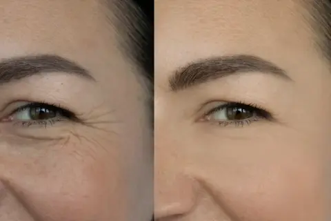 Przed i po zastosowaniu retinolu: widoczna redukcja zmarszczek wokół oka. Retinol co to? Składnik odmładzający skórę.