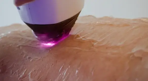 depilacja laserowa