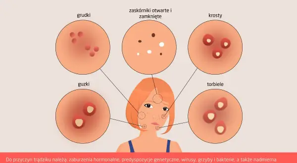 Ilustracja przedstawia różne rodzaje trądziku: grudki, zaskórniki, krosty, guzki i torbiele.