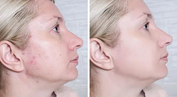 Przed i po: skóra z niedoskonałościami i zaczerwienieniami po zastosowaniu Acne Derm. Efekty widoczne od razu!