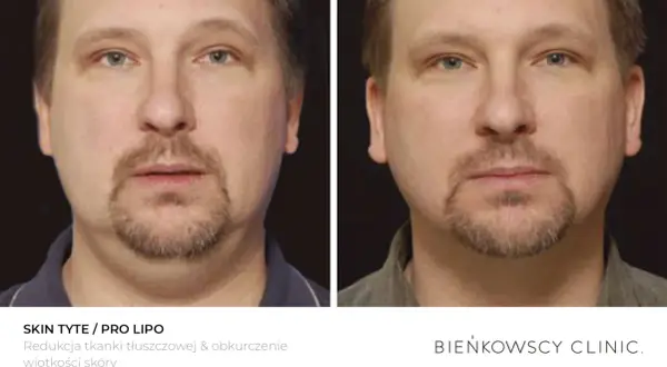 Przed i po zabiegu lipolizy iniekcyjnej. Widoczna redukcja tkanki tłuszczowej i obkurczenie skóry podbródka.