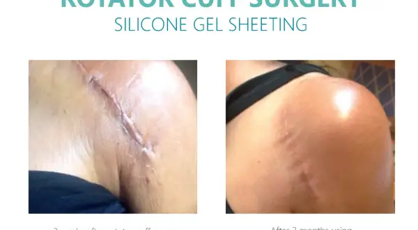 Po 3 tygodniach od operacji stożka rotatorów blizna jest widoczna. Po 3 miesiącach stosowania Silagen Sheeting i Pure Gel, blizna jest znacznie mniej widoczna.