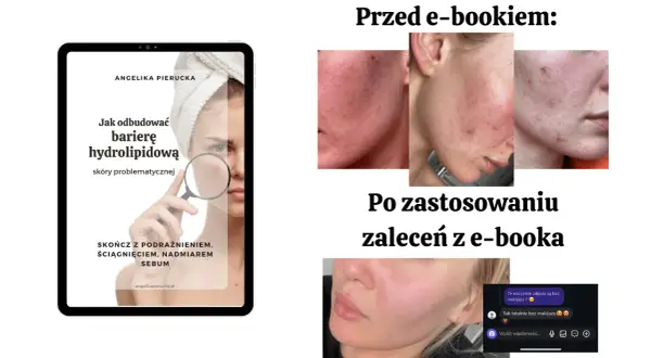 Skuteczne sposoby na czerwone plamy po pryszczach i ich redukcję