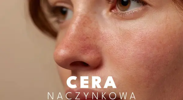 Zbliżenie na twarz z widocznymi rumieńcami i drobnymi naczynkami. Tekst: CERA NACZYŃKOWA.