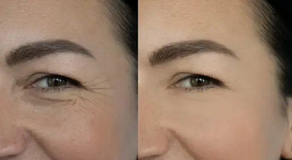 Przed i po zastosowaniu retinolu: widoczna redukcja zmarszczek wokół oka. Retinol co to? Składnik odmładzający skórę.