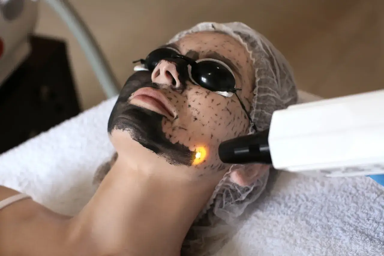 Kobieta w okularach ochronnych poddaje się zabiegowi peelingu węglowego. Laser skierowany na twarz.