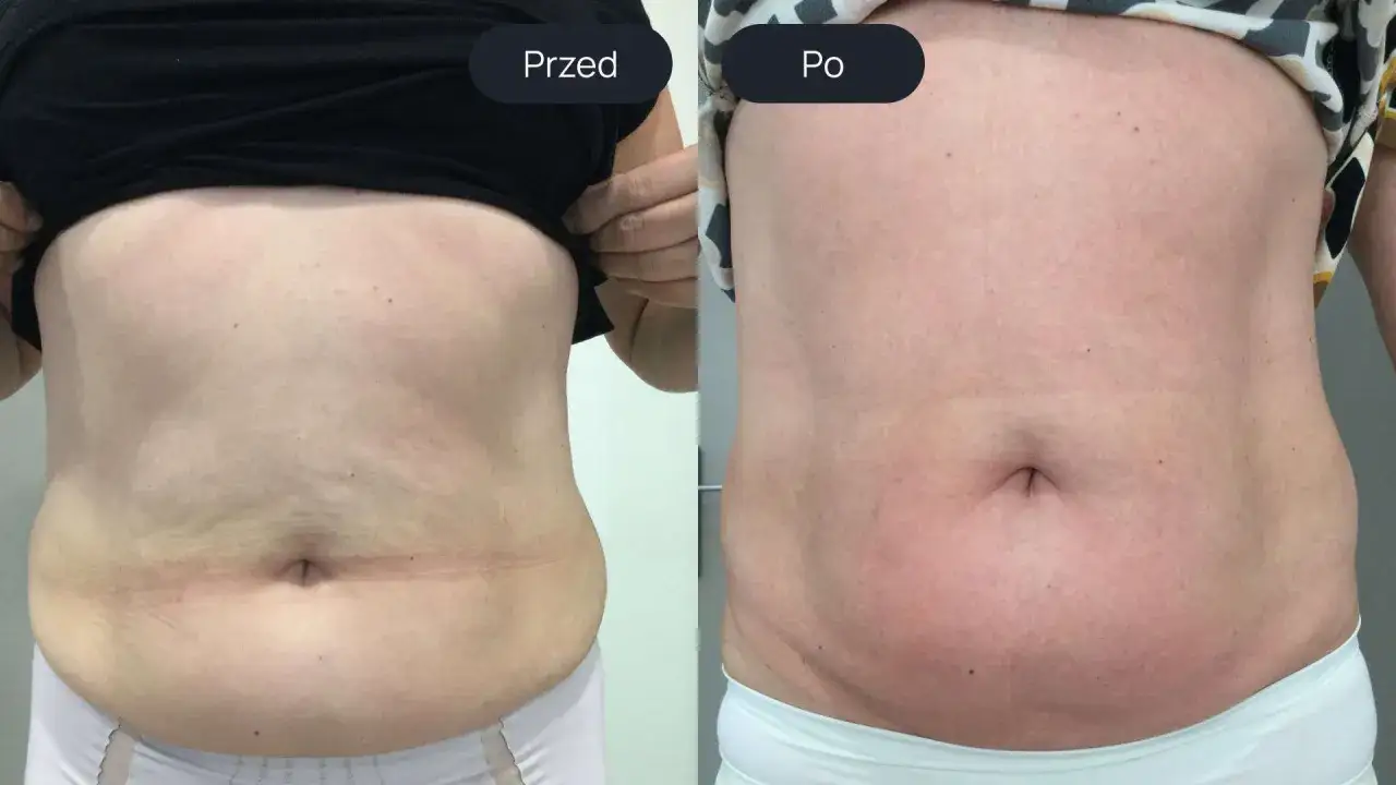 Porównanie brzucha przed i po zabiegu. Widoczne wyraźne endermologia efekty: wygładzenie skóry i redukcja tkanki tłuszczowej.