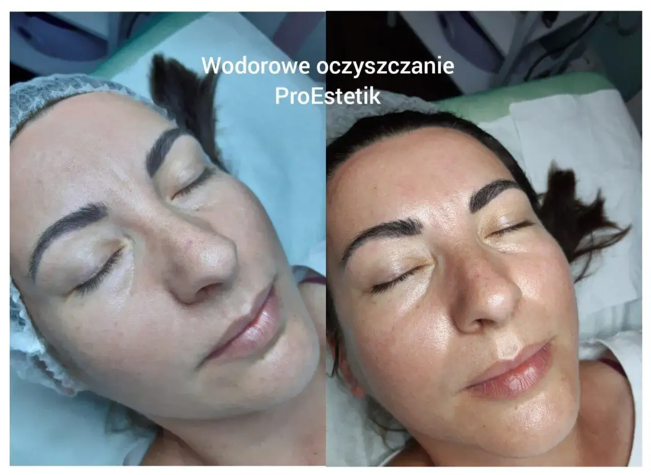 Efekt po zabiegu oczyszczania wodorowego twarzy. Skóra jest promienna i nawilżona.