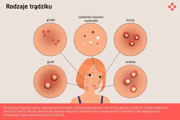 Ilustracja przedstawia różne rodzaje trądziku: grudki, zaskórniki, krosty, guzki i torbiele.