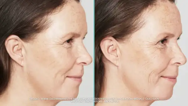 Porównanie skóry przed i po zabiegu skinbooster. Widać wygładzenie drobnych zmarszczek i poprawę nawilżenia.
