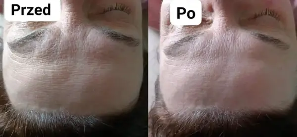 Przed i po zabiegu: zoga face wygładzona, zmarszczki na czole mniej widoczne.