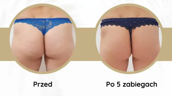 Widoczne **efekty endermologii** po 5 zabiegach: wygładzona skóra pośladków, redukcja cellulitu i poprawa jędrności.