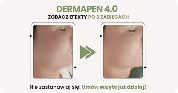 Przed i po zabiegu Dermapen 4.0: widoczne dermapen efekty po 3 zabiegach, skóra gładsza i bez niedoskonałości.