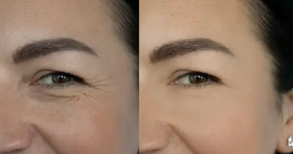 Przed i po zastosowaniu retinolu: widoczna redukcja zmarszczek wokół oka. Retinol co to? Składnik odmładzający skórę.