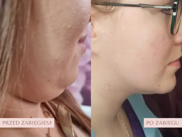 Lipoliza iniekcyjna efekty po 1 zabiegu: wyraźne wyszczuplenie podbródka, zredukowana podwójna broda.